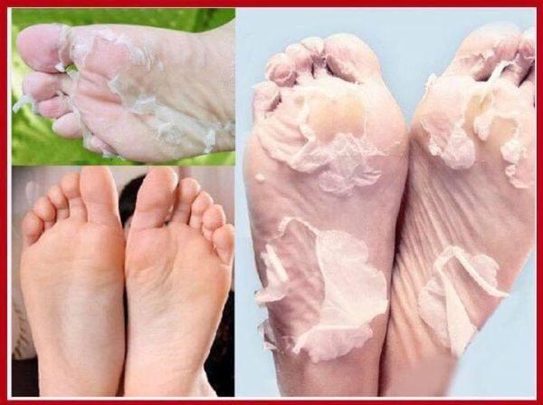 بوريدرم - التقشير قناع القدم أقدام لينة إزالة فرك كالوس الجلد الميت الثابت